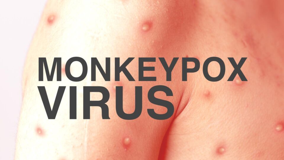 Monkeypox: What You Need to Know